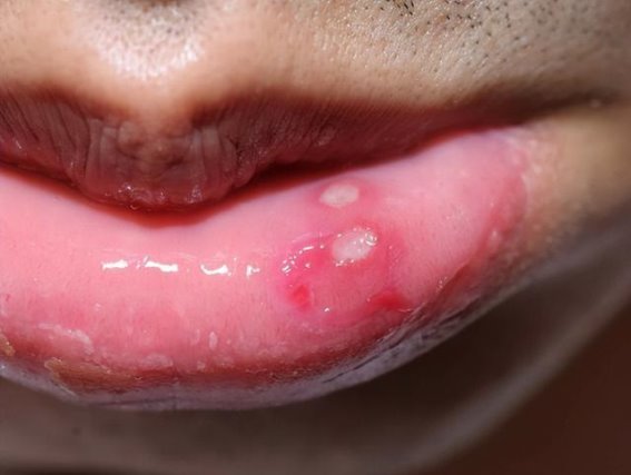 口腔溃疡的特殊情况与危害，预防与治疗方法详解